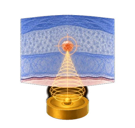 Focaliza: ondas convergen en un único punto de alta energía